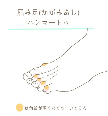 外反母趾 屈み足 扁平足 様々な足指の変形 あなたの悩みはどれ
