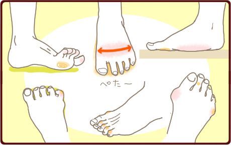 外反母趾 屈み足 扁平足 様々な足指の変形 あなたの悩みはどれ Part 2